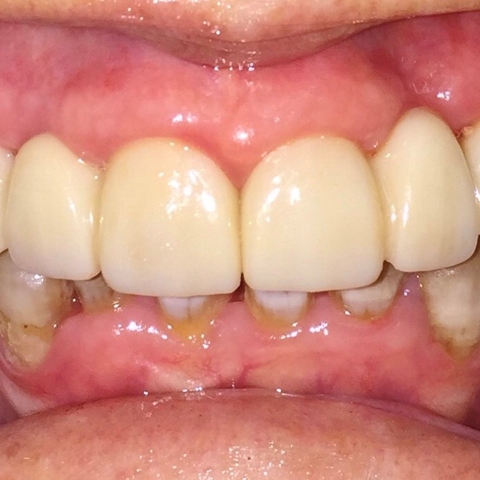 Crowns & Bridges Photo