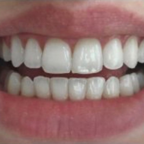 Invisalign Photo
