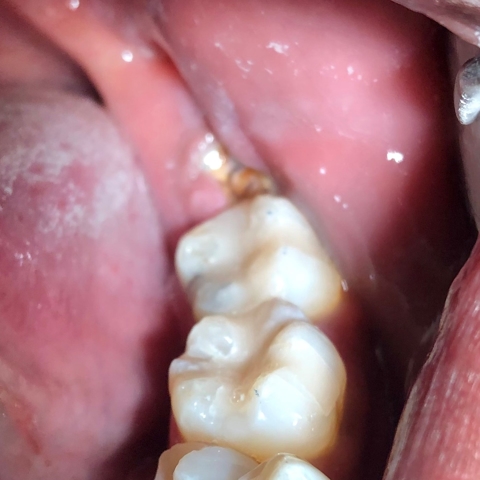 Tooth Colored Fillings Photo
