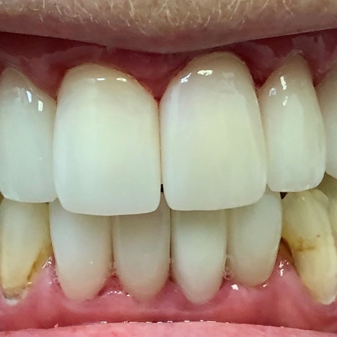 Veneers Photo